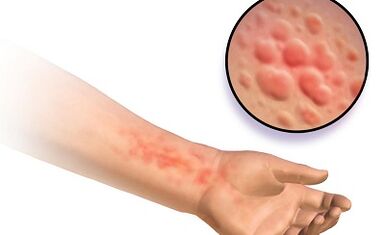 A manifestation of schistosomosis in people